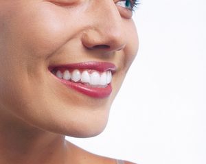 Smile Confidently With Invisalign braces | Swiss Smile 