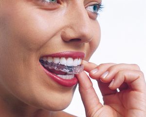 Clear removable INVISALIGN aligners to straighten the teeth | Swiss Smile 