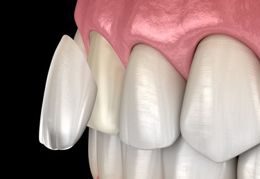 Veneers verbessern das Erscheinungsbild der Zähne  