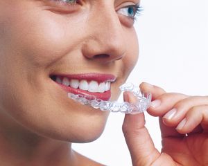 Invisalign teeth braces to align teeth | Swiss Smile 