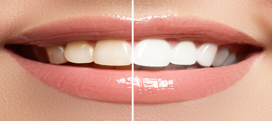 Express bleaching and express treatment | Swiss Smile 