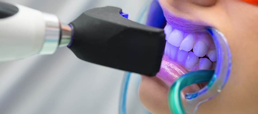 Express-Bleichen und Express-Behandlung | Swiss Smile