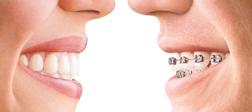 Zahnkorrektur mit sichtbaren und unsichtbaren Zahnspangen Schweizer Lächeln | Swiss Smile  