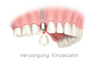 Zahnimplantate für Einzelzahnersatz und große Zahnlücken | Swiss Smile  