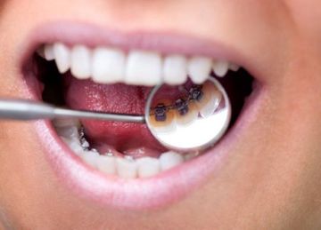 Linguale Zahnspange Die Unsichtbare Zahnspange Zahnarztzentrum Swiss Smile
